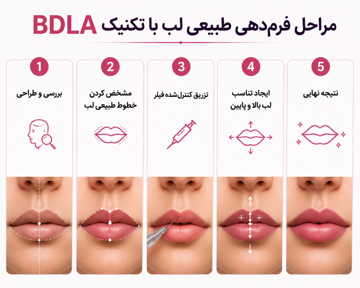 مراحل فرم دهی لب با تکنین BDLA