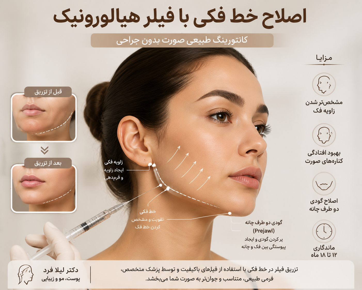 اصلاح خط فکی با فیلر هیالورونیک