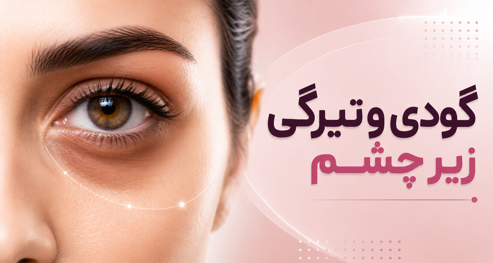 گودی و تیرگی زیر چشم؛ چرا برای همه یک درمان جواب نمی‌دهد؟
