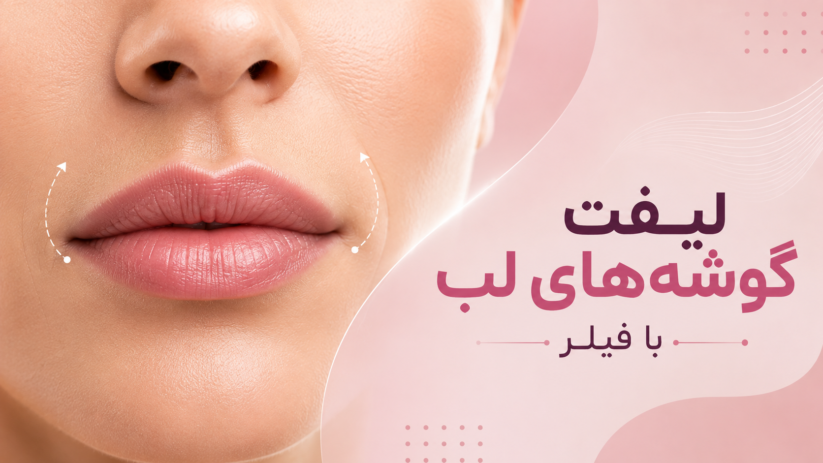لیفت گوشه لب با فیلر؛ آیا می‌توان حالت افتاده دهان را طبیعی اصلاح کرد؟
