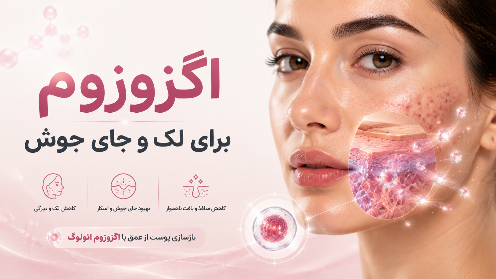 اگزوزوم برای لک، جای جوش و منافذ پوست چگونه عمل می‌کند؟
