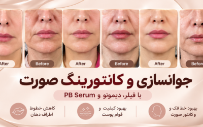 نمونه کار جوانسازی و کانتورینگ صورت با فیلر، دیمونو و PB Serum