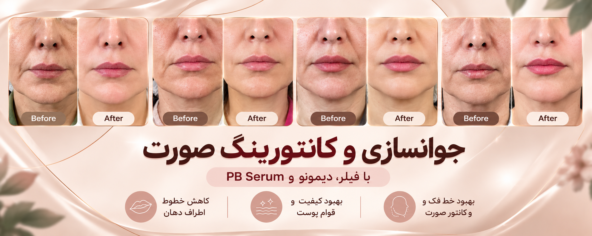 نمونه کار جوانسازی و کانتورینگ صورت با فیلر، دیمونو و PB Serum