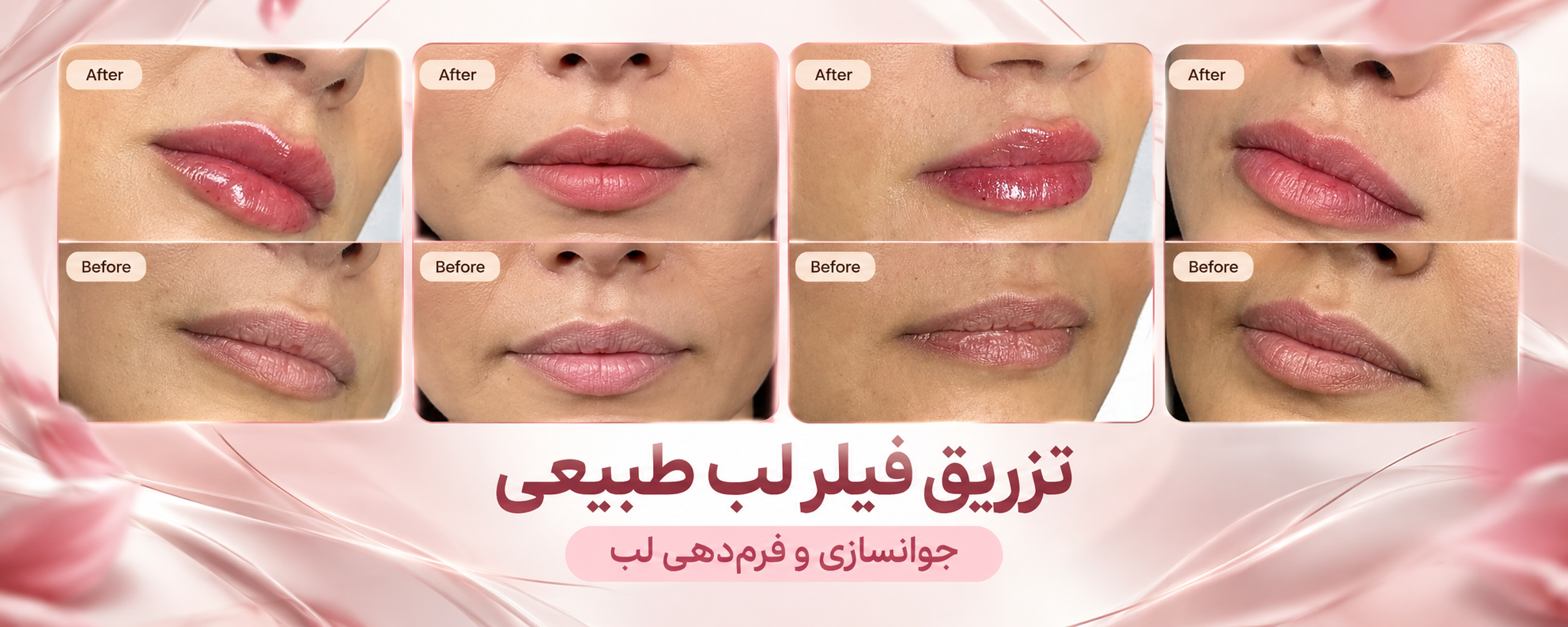 نمونه کار تزریق فیلر لب طبیعی؛ جوانسازی و فرم‌دهی لب