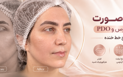 نمونه کار لیفت صورت با نخ اپتوس و PDO؛ اصلاح گودی خط خنده