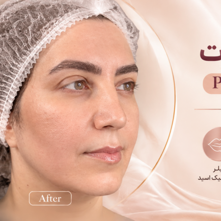 نمونه کار لیفت صورت با نخ اپتوس و PDO؛ اصلاح گودی خط خنده