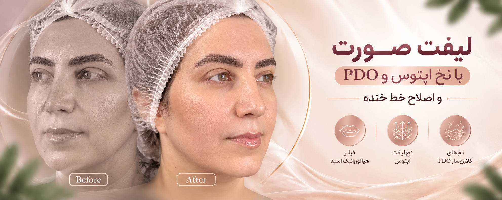 نمونه کار لیفت صورت با نخ اپتوس و PDO؛ اصلاح گودی خط خنده