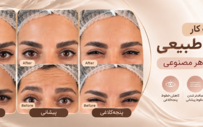 نمونه کار بوتاکس طبیعی؛ کاهش خطوط صورت بدون ظاهر مصنوعی