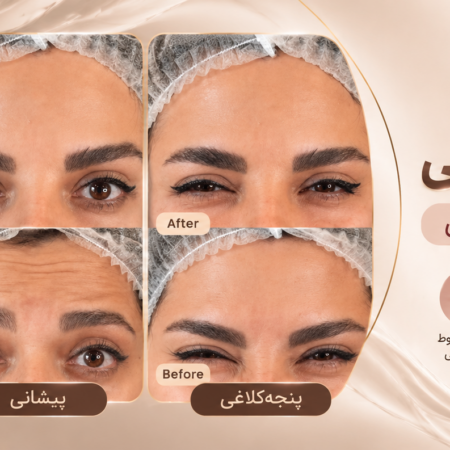 نمونه کار بوتاکس طبیعی؛ کاهش خطوط صورت بدون ظاهر مصنوعی