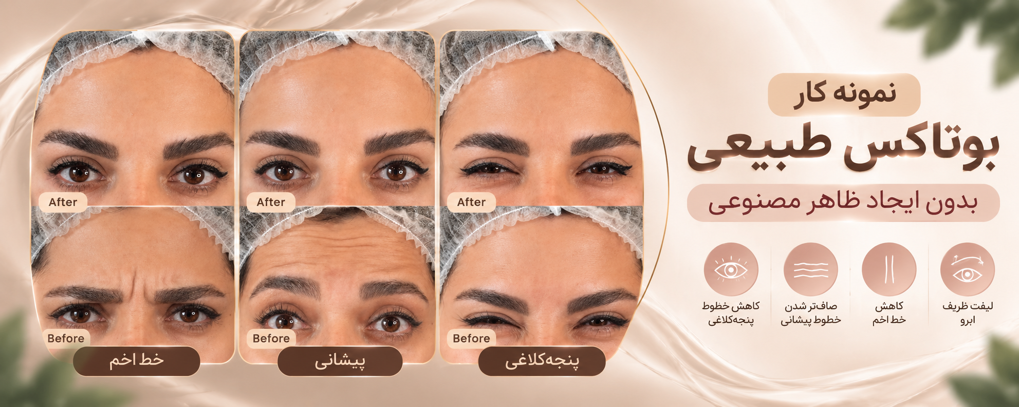 نمونه کار بوتاکس طبیعی؛ کاهش خطوط صورت بدون ظاهر مصنوعی