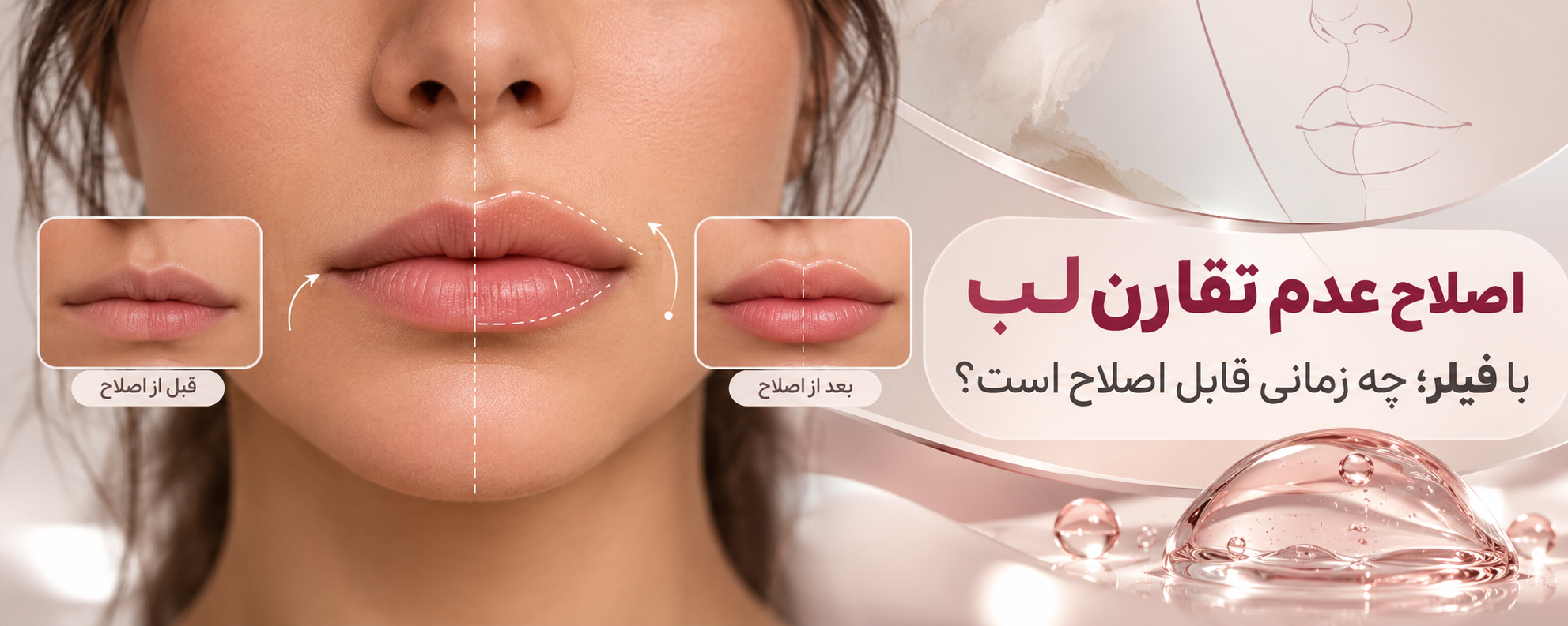 اصلاح عدم تقارن لب با فیلر؛ چه زمانی قابل اصلاح است؟
