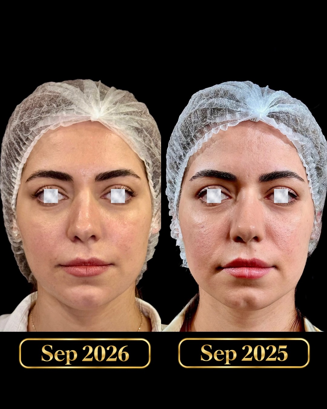 نمونه کار جوانسازی صورت 1