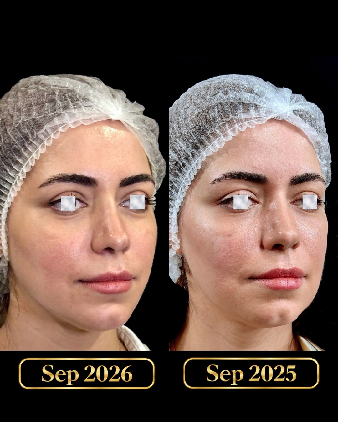 نمونه کار جوانسازی صورت 2
