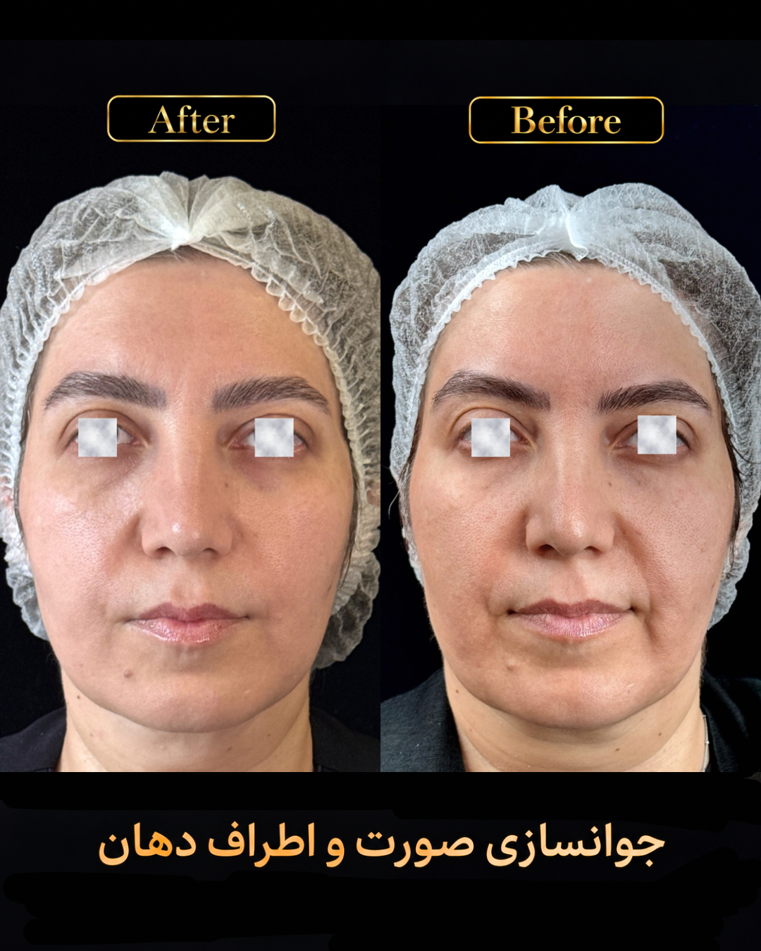 نمونه کار اصلاح گودی خط خنده 1