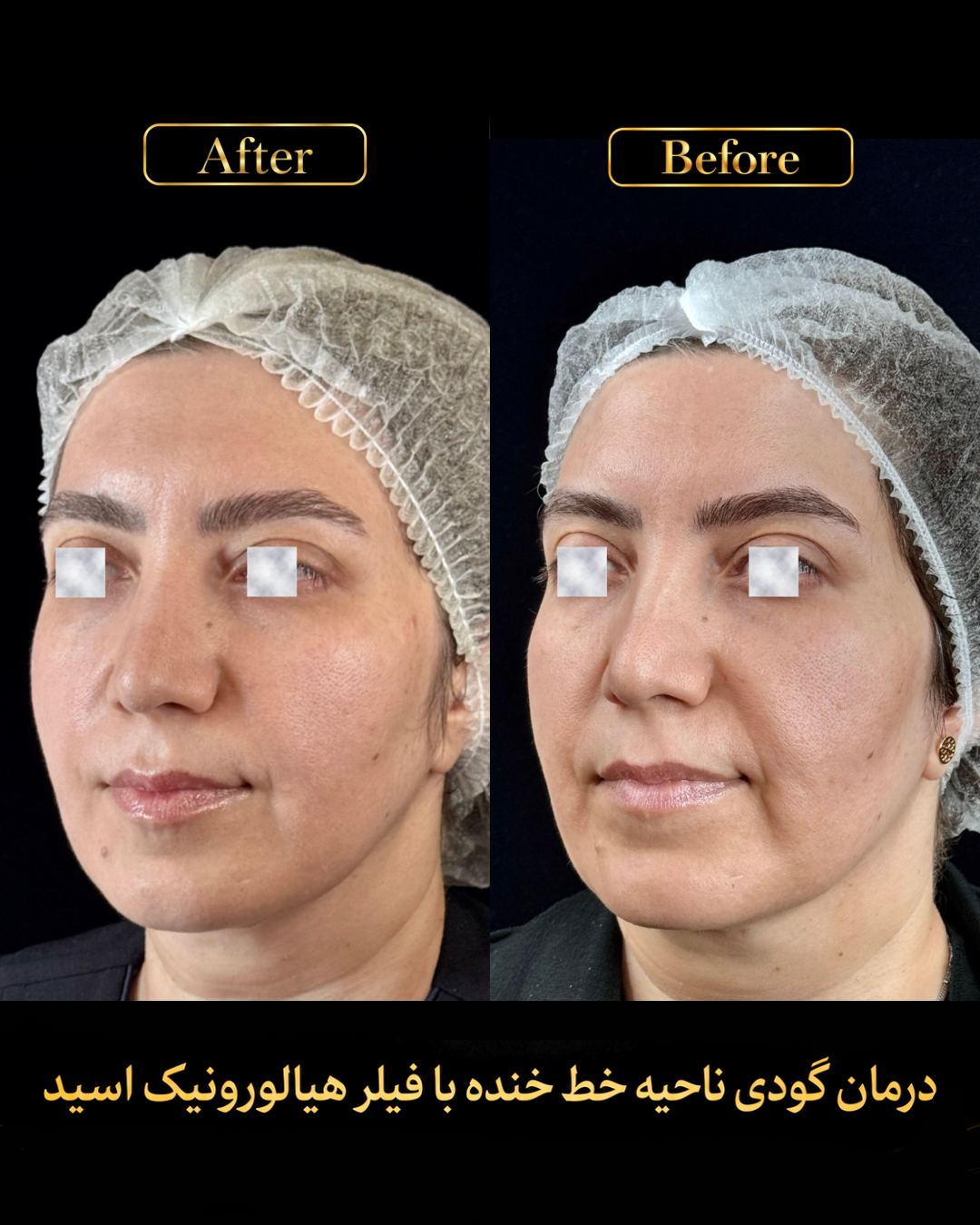نمونه کار اصلاح گودی خط خنده 2