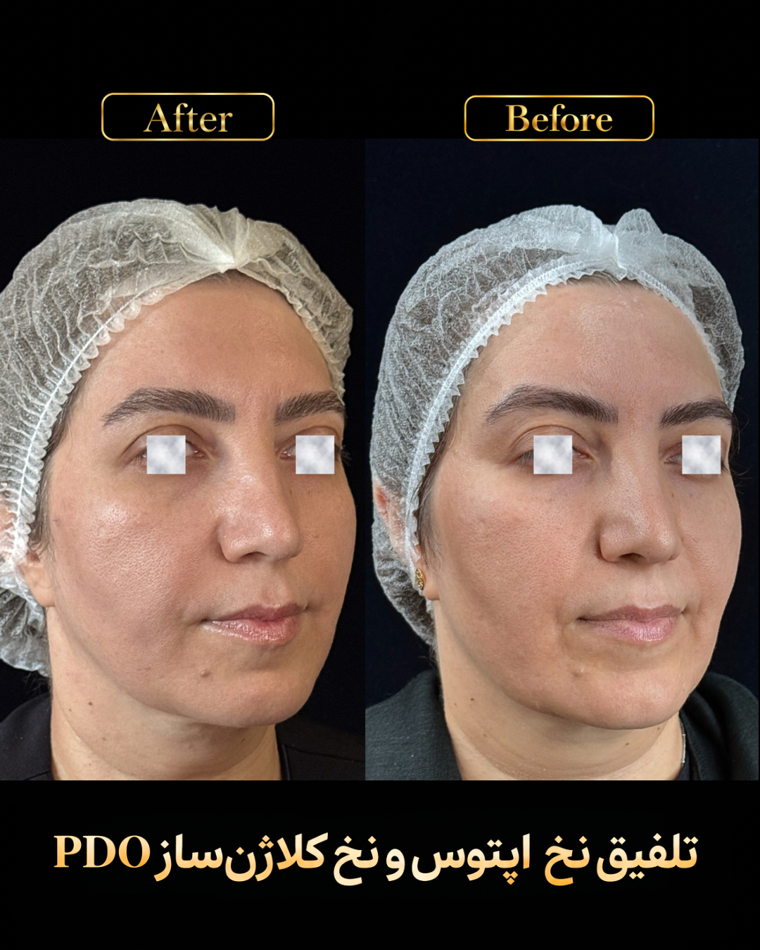 نمونه کار اصلاح گودی خط خنده 3