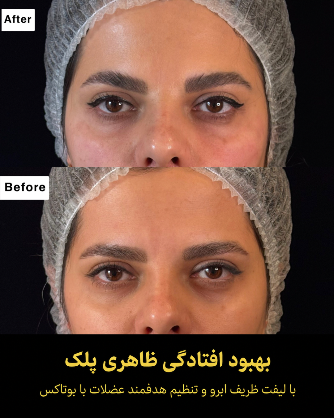 نمونه کار تزریق بوتاکس 1