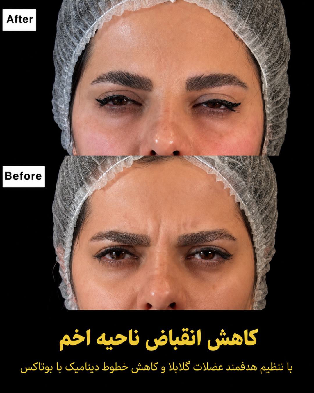 نمونه کار تزریق بوتاکس 2