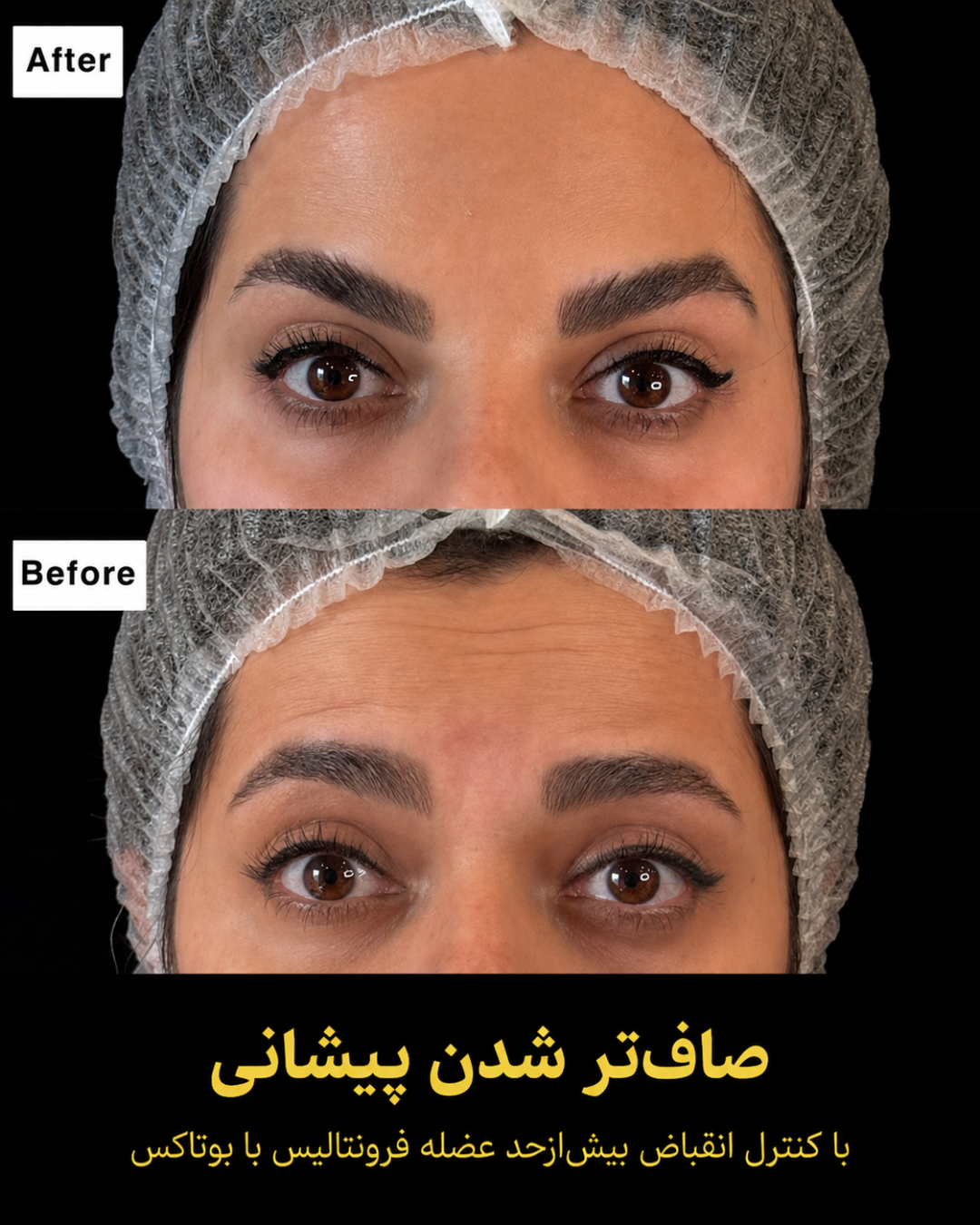 نمونه کار تزریق بوتاکس 3
