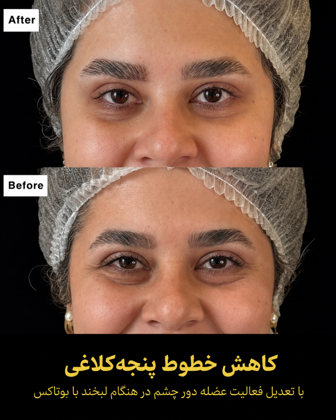 نمونه کار تزریق بوتاکس 4