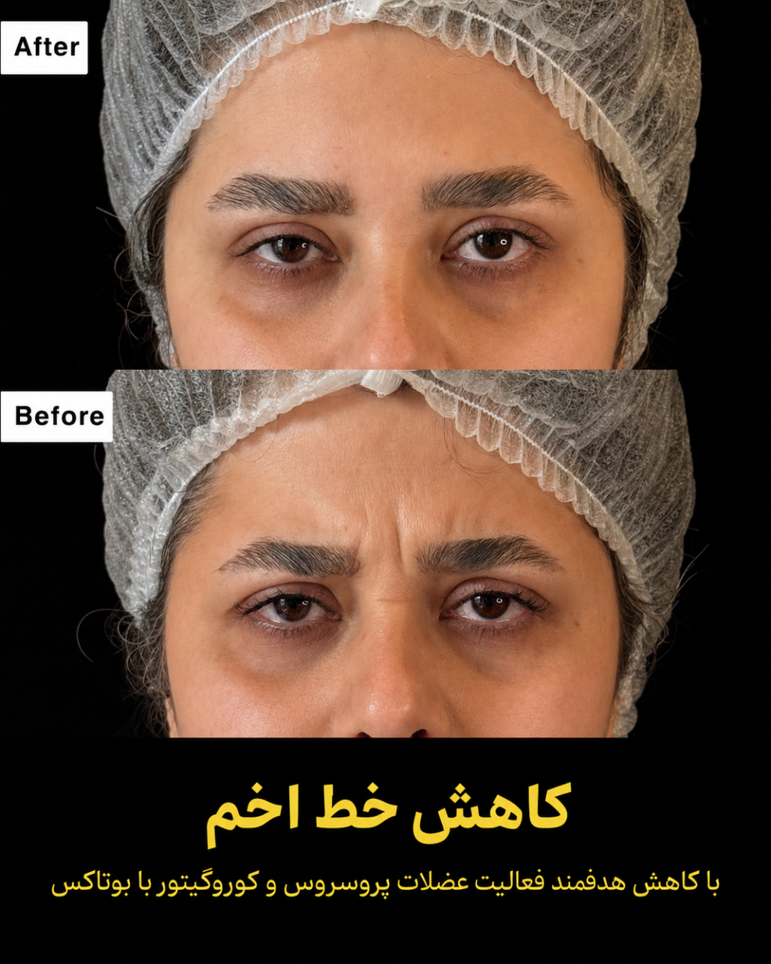 نمونه کار تزریق بوتاکس 5