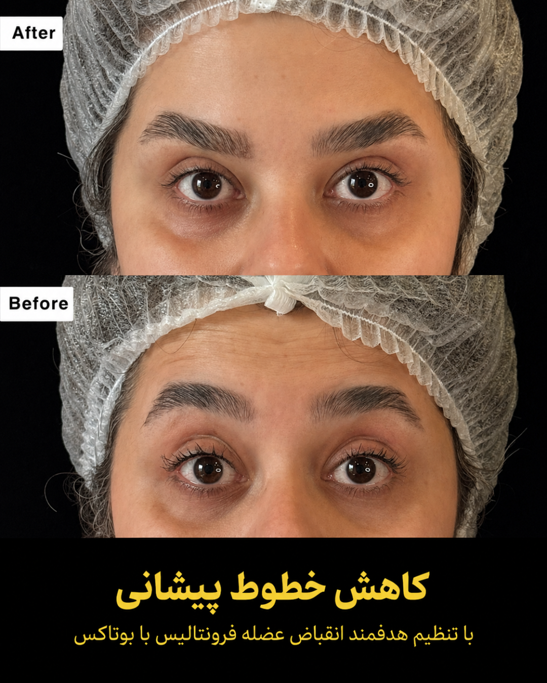 نمونه کار تزریق بوتاکس 6