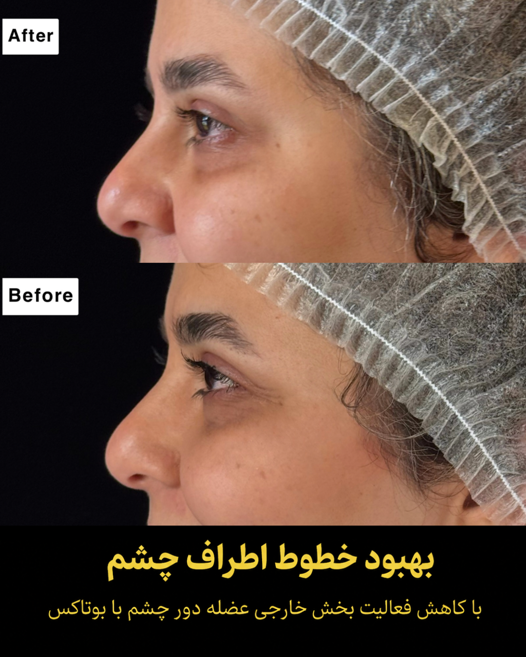 نمونه کار تزریق بوتاکس 7