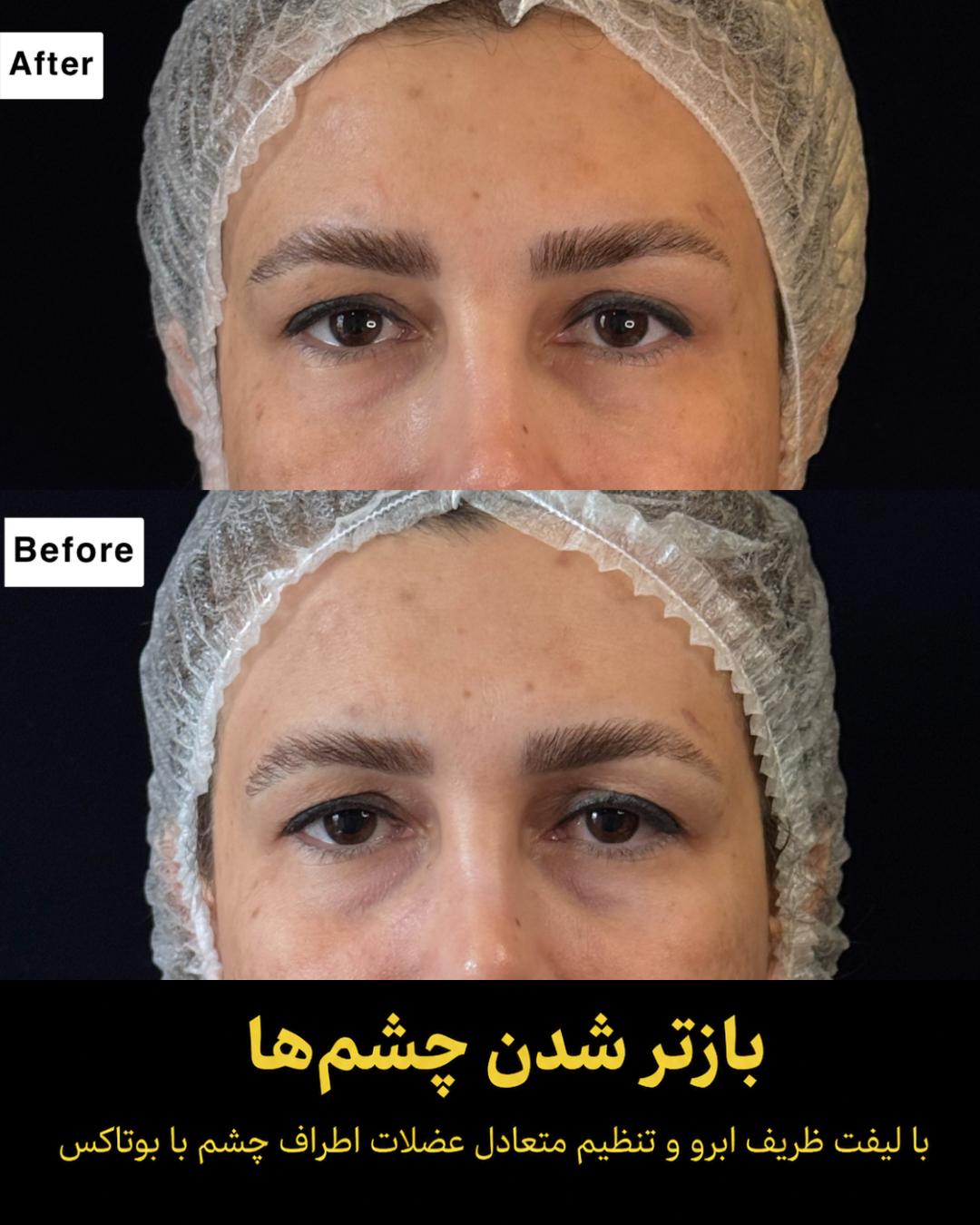 نمونه کار تزریق بوتاکس 8