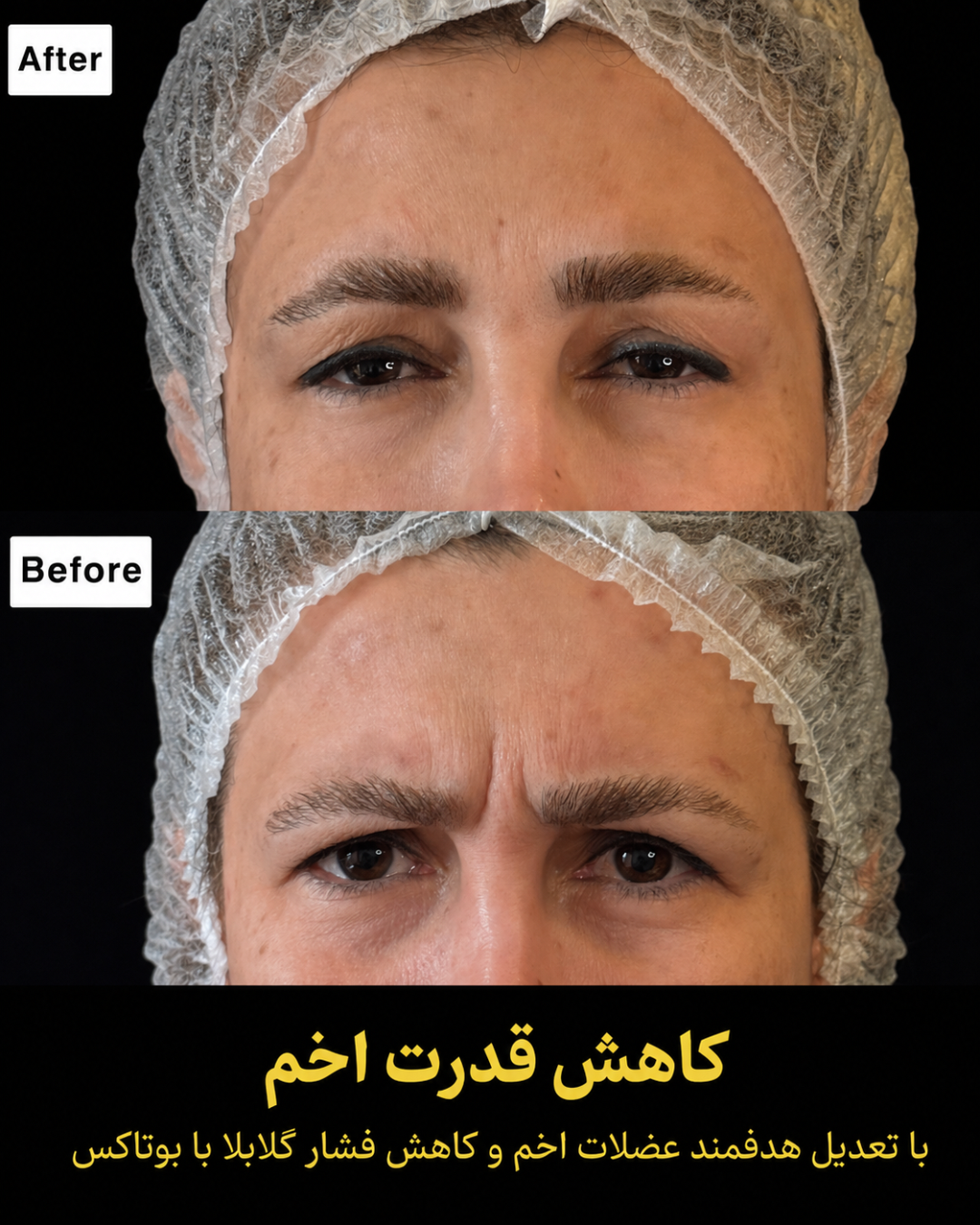 نمونه کار تزریق بوتاکس 9