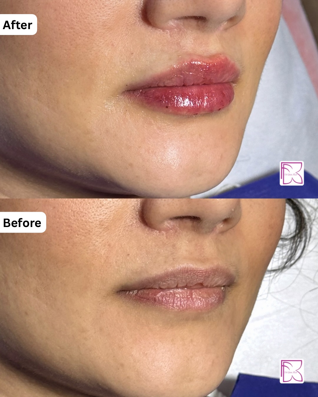 نمونه کار تزریق فیلر لب طبیعی 1
