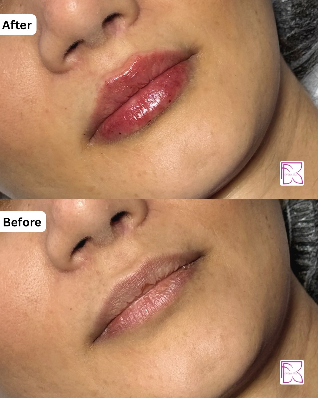 نمونه کار تزریق فیلر لب طبیعی 2