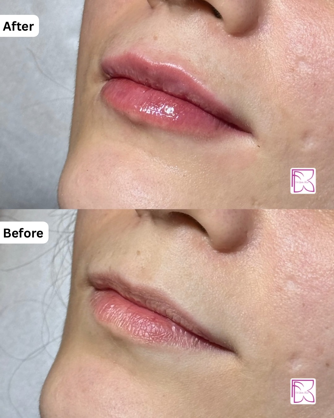نمونه کار تزریق فیلر لب طبیعی 3