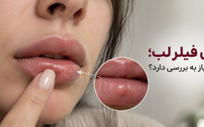 گوله شدن فیلر لب؛ چه زمانی طبیعی است و چه زمانی باید بررسی شود؟