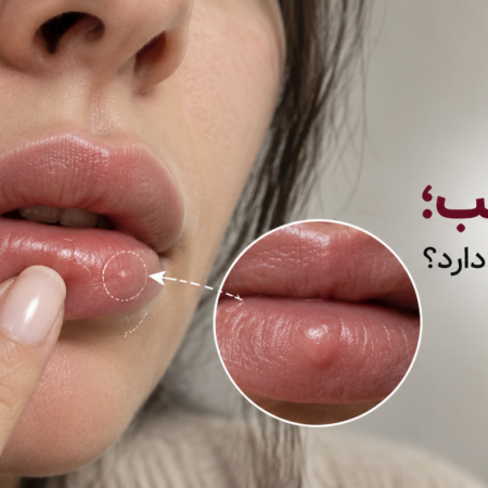 گوله شدن فیلر لب؛ چه زمانی طبیعی است و چه زمانی باید بررسی شود؟