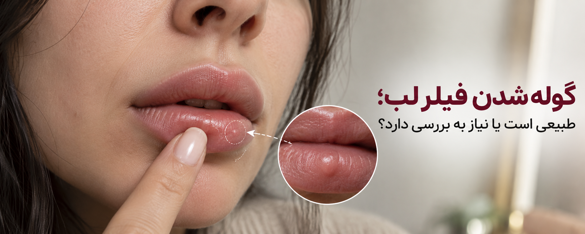 گوله شدن فیلر لب؛ چه زمانی طبیعی است و چه زمانی باید بررسی شود؟