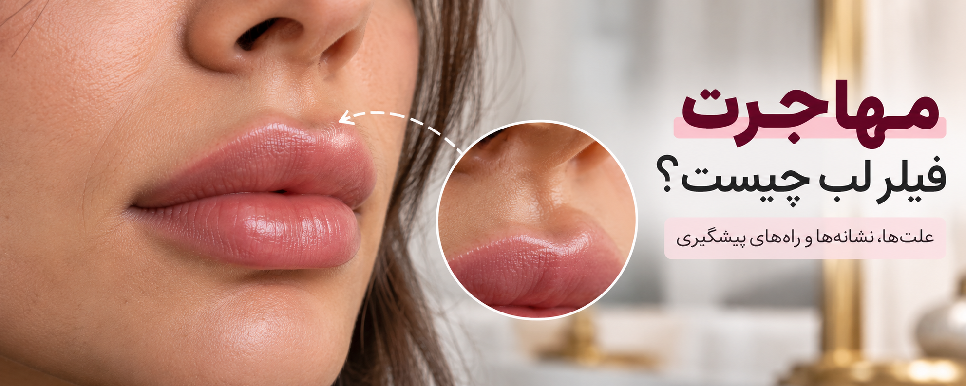 مهاجرت فیلر لب چیست؟ علت‌ها، نشانه‌ها و راه‌های پیشگیری